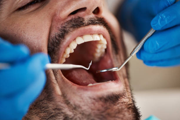 Best Cracked Tooth Emergency Dentist  in East Palo Alto, CA